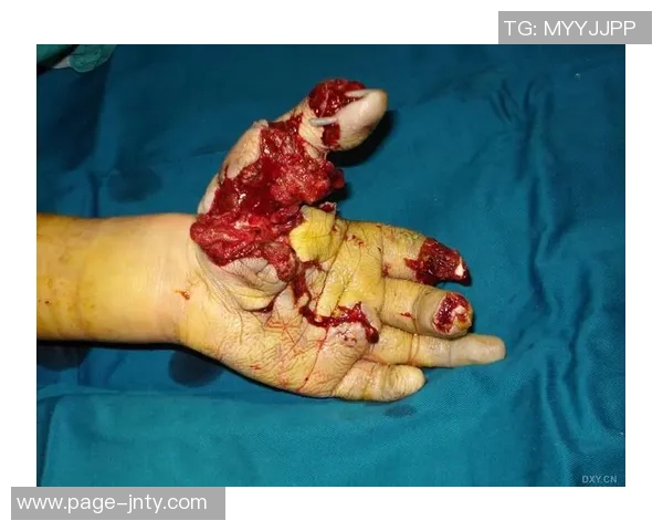 亚特兰大与罗马比赛中边裁遭鞭炮炸伤幸好无大碍